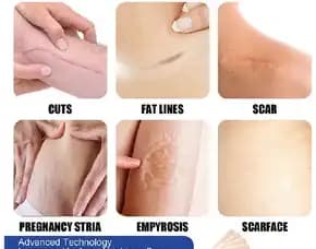 Silicone Scar Sheet Lester Silikon Penghilang Keloid Bekas Luka